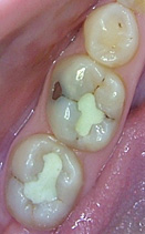 cerec1