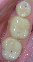 cerec2