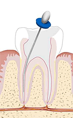 endodotie1