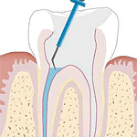 endodotie2